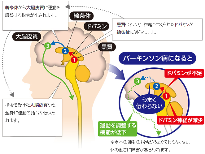 若年性パーキンソン病を予防するためのヒント