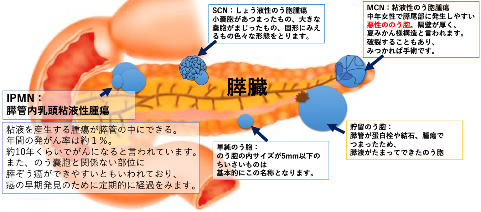 膵のう胞 | 治療と運動｜ATTiVO Body Care GYM（アッティーヴォ・ボディケアジム）
