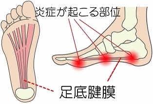 足底筋膜炎 画像